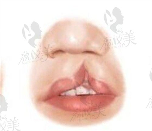 成都医大李辉唇裂技术好西南有名,唇腭裂修复细致形态正常3.5W起