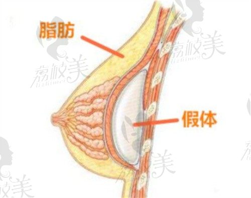 上海谢卫国是隆胸口碑好的医生，复合式隆胸价格5万起自然又动感