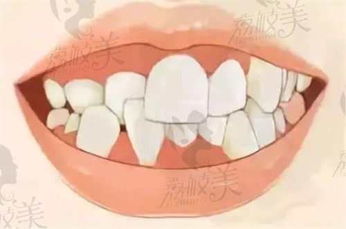 牙齿符合这些条件才能正颌直术，来看正颌直术和先正畸再正颌区别
