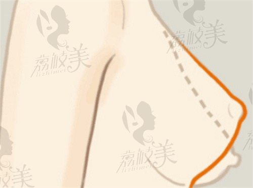 上海华美巨乳缩小手术价格7w起，李健医生缩胸术同时解决乳房下垂