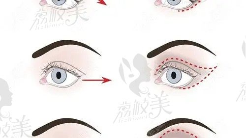 大连刘志刚修复双眼皮自然有神，切开双眼皮修复肉条疤痕起价58000元