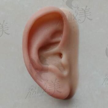 盘点外耳再造手术需要多少费用,含郭树忠/章国庆/张如鸿耳再造价格
