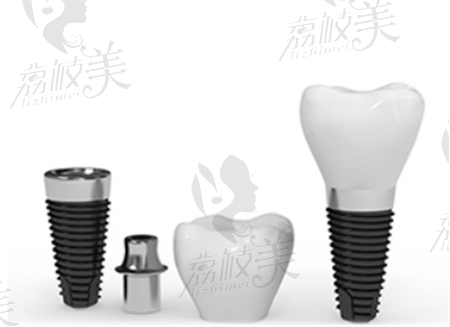 北京斯迈尔口腔种植牙价格表来了，韩国登腾种植牙集采价1070元起