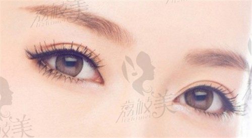 广州中家医刘兵做双眼皮综合手术8000元起，术后自然闭眼无痕