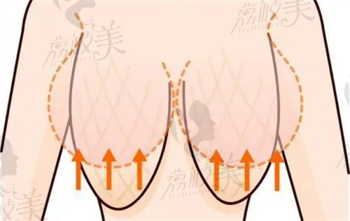 中山美南华乳房下垂矫正有办法，张立明医生矫正胸部下垂2.6w起