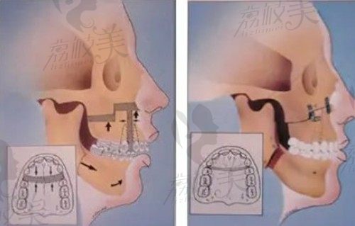 上海双鄂手术量大的医生排名前3有朴兴植,附朴兴植双颚价格