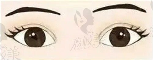 武汉五洲王志做眼睛怎么样？从我双眼不对称修复后的图看技术确实好