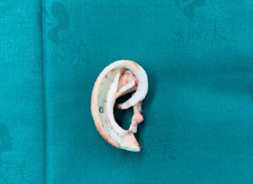 成人可以做耳再造吗?18岁|32岁|55岁都可以做耳再造手术附费用详情