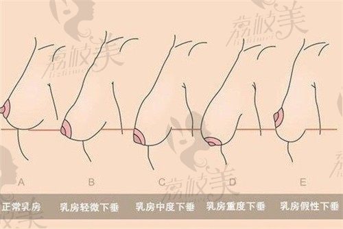 武汉江城整形郭晓冬做乳房下垂矫正技术好，重获挺翘胸部仅需3w起
