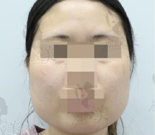 亲身体验韩国欧佩拉金锡汉轮廓整形，这款妈生V脸算是让我捡到了