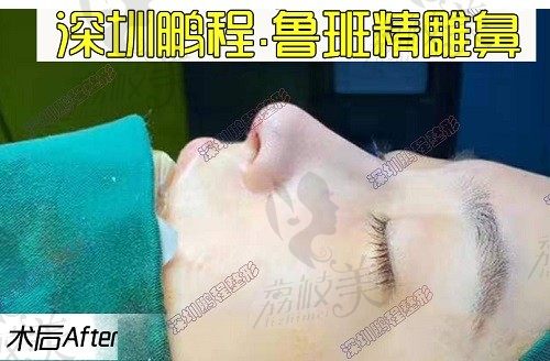 深圳刘冰医生做鼻子真的是妙鼻生花，不到两万就可以做鲁班精雕鼻