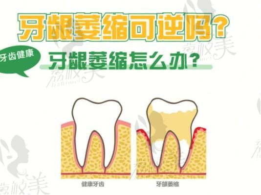 牙龈萎缩是肾气不足引起的吗？牙龈萎缩松动有没办法挽救牙齿