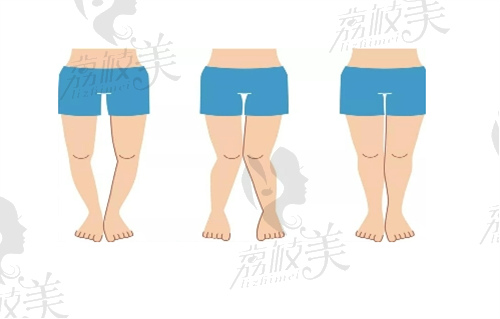 成都玉之光刘中国脂肪填充矫正腿型1.7万起,术后自然没风险