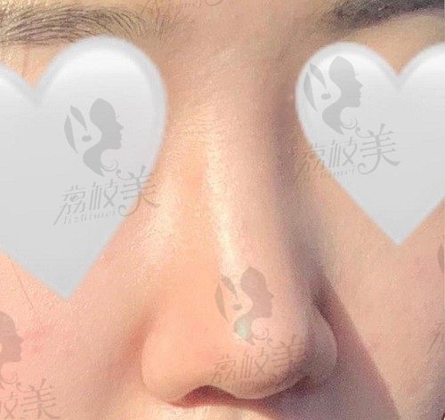 打卡韩国歌柔飞鲁峰一隆鼻项目，3D打印定制小翘鼻真的太自然了