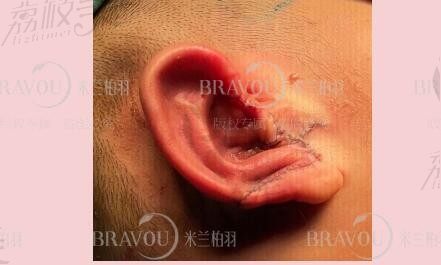 耳朵畸形整形可以用社保报销吗?这些耳再造医院有治疗耳朵畸形补助政策