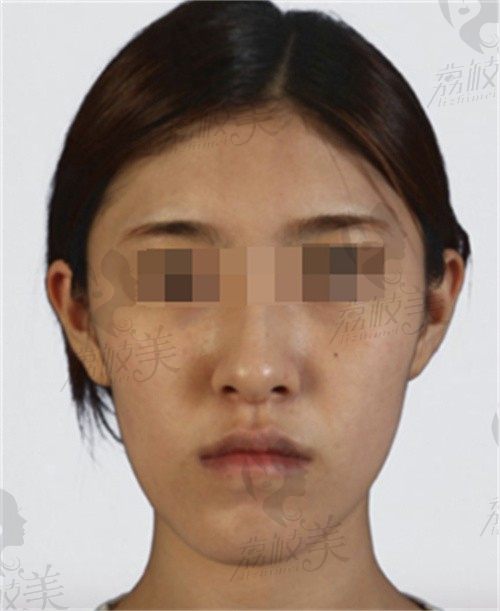 韩国BK整形外科医院做下巴手术确实绝，歪下巴改善后脸型也周正了
