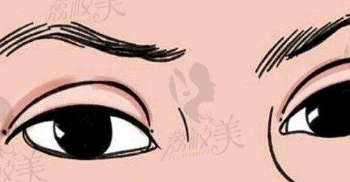 郑州集美刘德辉双眼皮修复技术靠谱，高难度眼部修复仅1.4w元起
