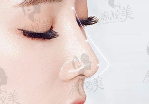 深圳富华唐新辉院长做鼻子怎么样？能反映问题的隆鼻技术实力来了
