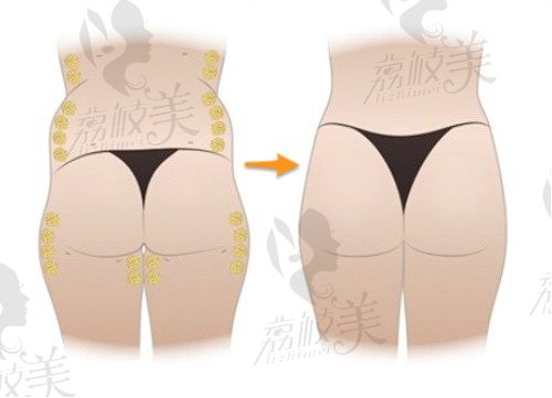 杭州星光丽格自体脂肪丰臀价格3万起，汪峰亲诊脂肪填充术后get蜜桃臀