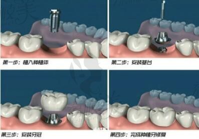 种植牙最难受的环节是哪一个步？详解种植牙一期二期三期流程需要去几次？