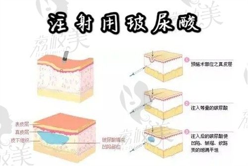 上海華美玻尿酸經(jīng)過查詢都是真的，瑞藍(lán)/喬雅登玻尿酸都是合作品牌