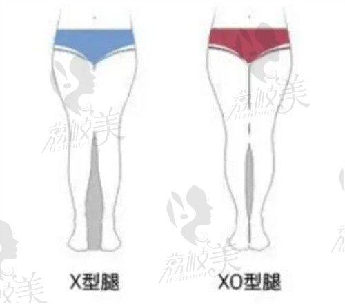 找杭州郭同荣医生做腿型矫正过程分享，术后终于拥有漫画腿