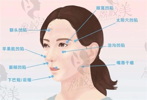 西安美莱钱从平医生做脂肪填充面部能改善脸部凹陷,价格1.8万塑造幼态脸