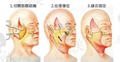 长沙拉皮手术哪个医院做的好？选长沙拉皮除皱美容医院前十不会错