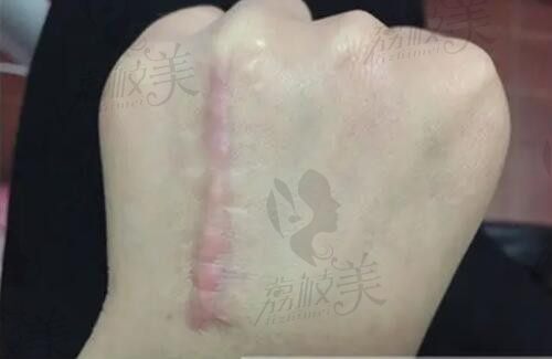 广州有名的祛疤医院十大排名,曙光/燕岭等疤痕修复正规医院收费实惠
