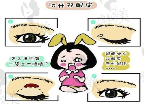 杭州维多利亚刘中策做眼睛技术好，双眼皮术后自然灵动价格仅1万起
