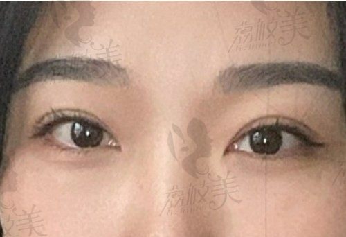 南京美贝尔黄名斗做眼睛技术yyds，割双眼皮技术靠谱超美超自然