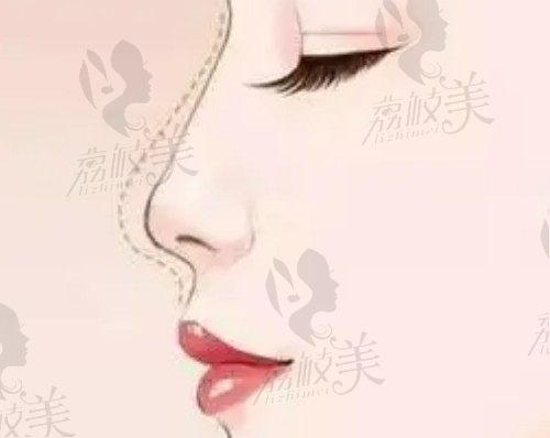 南京美贝尔陈刚医生做鼻子挺有名，用射极峰膨体隆鼻2.5w起好自然
