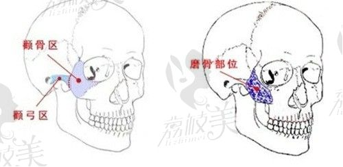上海韩镜吉玟锡磨骨技术确实好，做颧骨内推6w起轻松摆脱菱形脸