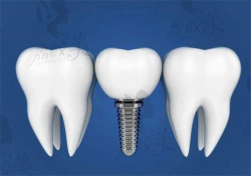 成都种植牙多少钱一颗2023，排名榜上这5家正规医院收费很良心
