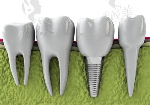 大连种植牙集采什么时候落地?4月20日起种牙价格平均下降55%