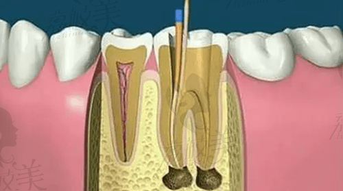 牙齿根管治疗后还会复发吗？看完牙齿根管治疗全过程就明了
