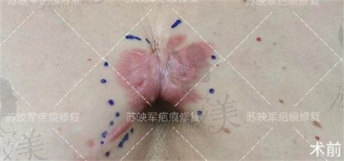 西安国医整形找苏映军做疤痕疙瘩切缝实例分享，疤痕修复技术真的牛