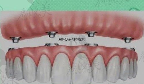 上海全口种植牙收费价目表：含雅悦、鼎植、罗缘满口种植牙价格