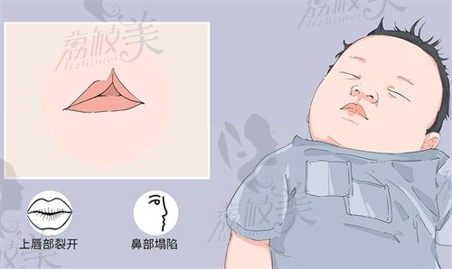 分享南京唇腭裂修复做得好的医院排名，这几家修复唇腭裂技术都不错