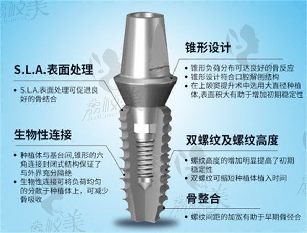 韩国美格真种植体的优缺点及价格已罗列，来瞅和登腾哪个好