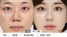 我宣布韩国gng做鼻子价格，无假体隆鼻550万+自体肋软骨1100万韩币