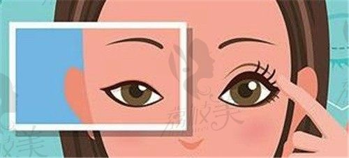 找上海艺星许炎龙医生做双眼皮过程分享，术后眼睛超惊艳