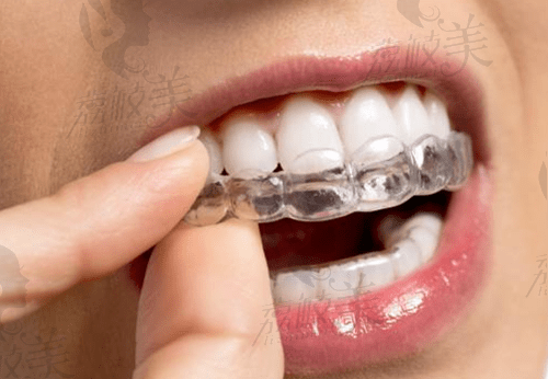 30岁整牙是不是太晚了？成人矫正牙齿的利与弊有哪些