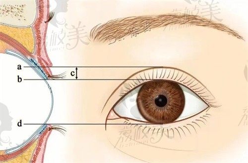 青岛诺德林建新做双眼皮超自然，眼部综合5项1.5w起解锁灵动大眼