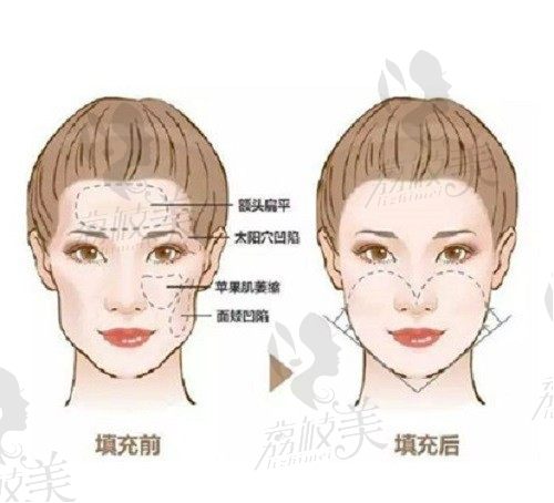 郑州李永峰做面部脂肪填充怎么样？成活率很高的精细化填充就是美