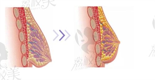 有深圳南雅医疗美容预约电话,花苞提胸/超脂塑吸脂挂号方便!