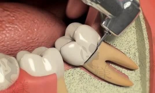 为什么医生都不建议微创拔牙？微创和普通拔牙有什么区别呢