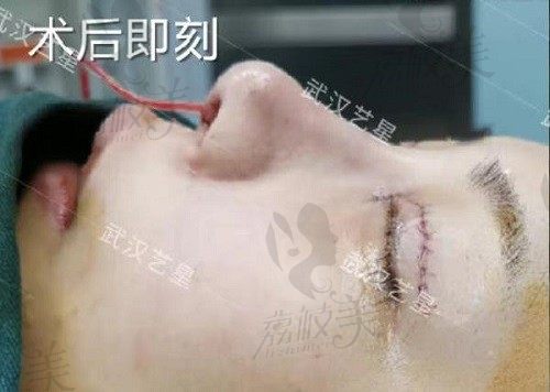 打卡武汉艺星杨国梁眼修复+半肋假体鼻综合，对比实例反馈不吹不黑