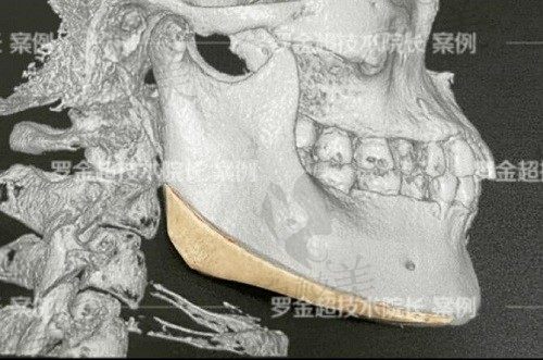 罗金超下颌角技术很高超，拿手下颌角连续弧形截骨术仅需3.3W元起