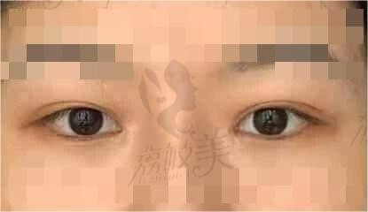 杭州维多利亚刘中策做眼睛技术真赞，隐痕双眼皮轻松get！
